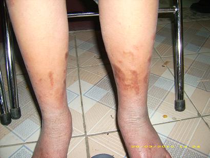 Những vết sẹo ở đôi chân Bắc - Ảnh: Nguyễn Dược